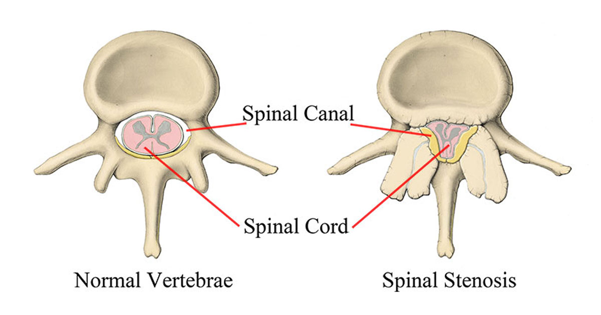 Spinal Stenosis  What Causes Narrowing of your Spine or Backbone?