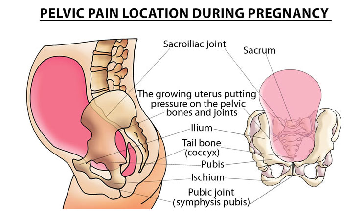 What is pelvic girdle pain in pregnancy, and how do I relieve it