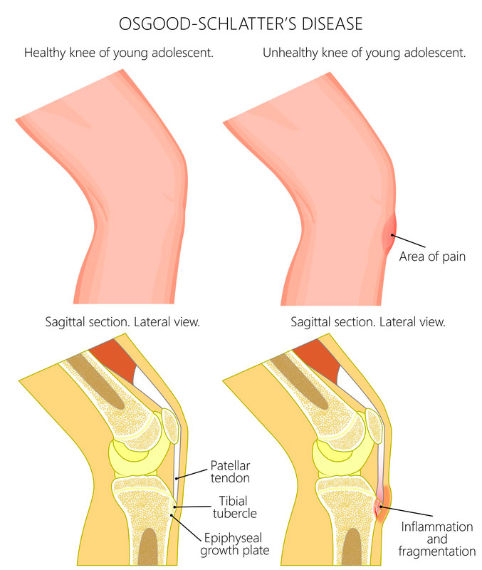 osgood-schlatter-s-disease