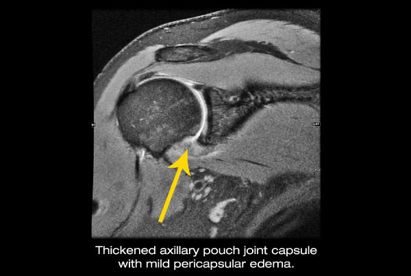 10 Facts About Frozen Shoulder