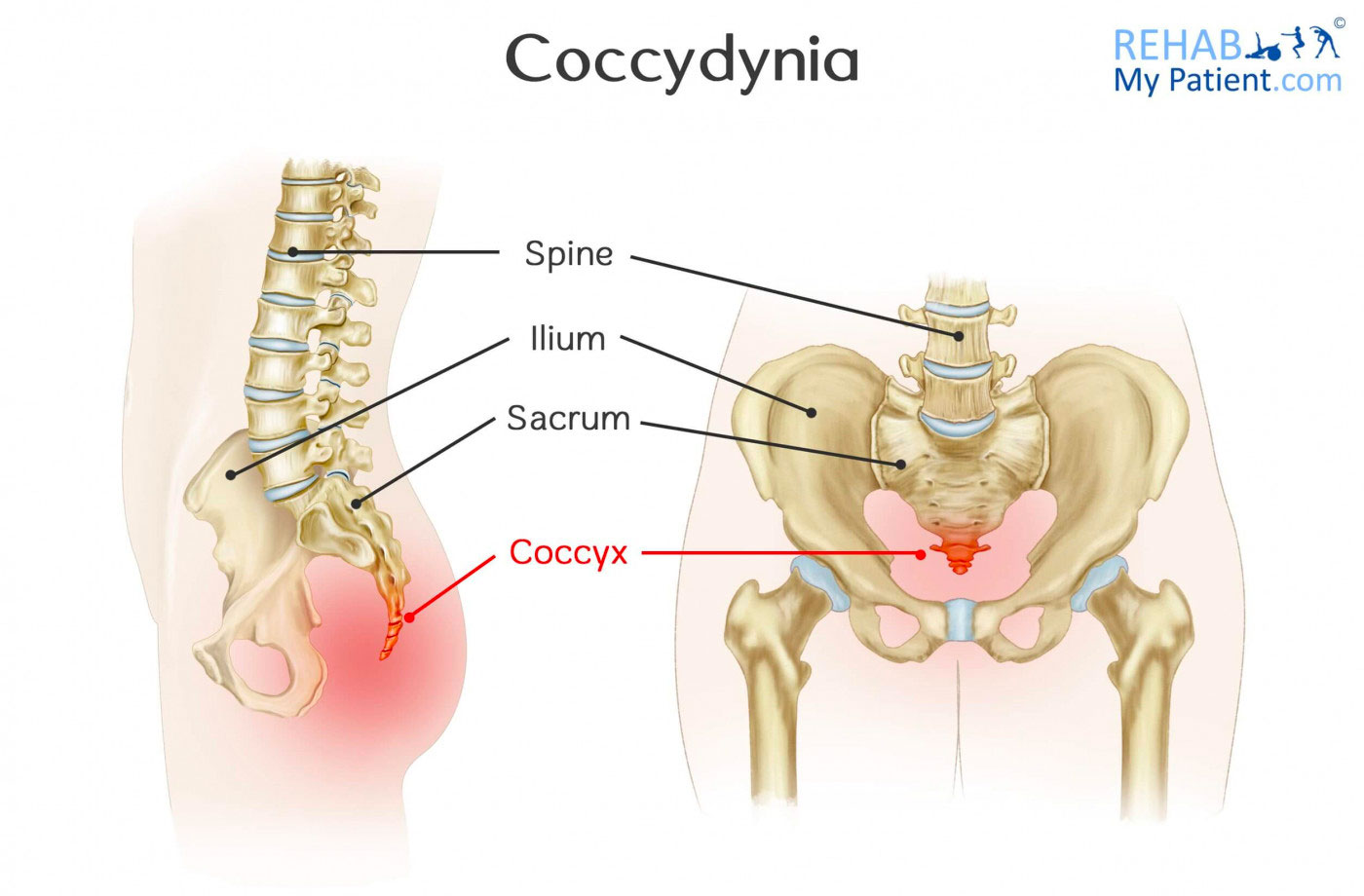 Tailbone Pain (Coccydynia): Causes and Treatment