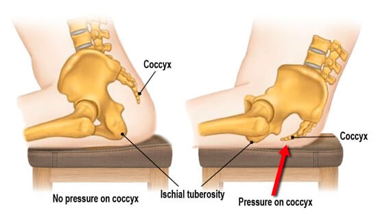 Tailbone Pain (Coccydynia): Causes, Symptoms & Treatment